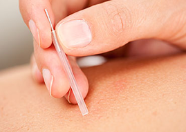 Close up of an Acupuncture needle being inserted