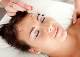 Woman getting Acupuncture treatment forehead